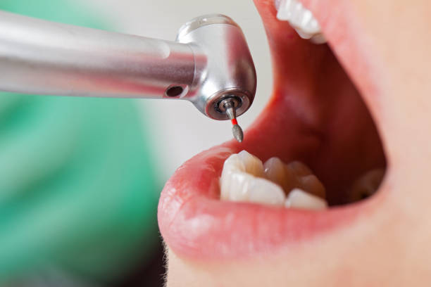 Best Emergency Dentist for Lost Fillings or Crowns in West Kittanning, PA
